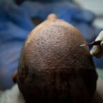 Como a Turquia invadiu a indústria de transplante capilar